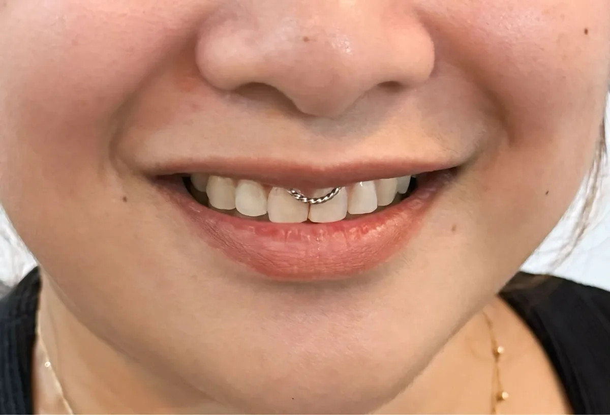 Smiley piercing with a twisted silver ring showing above the front teeth
