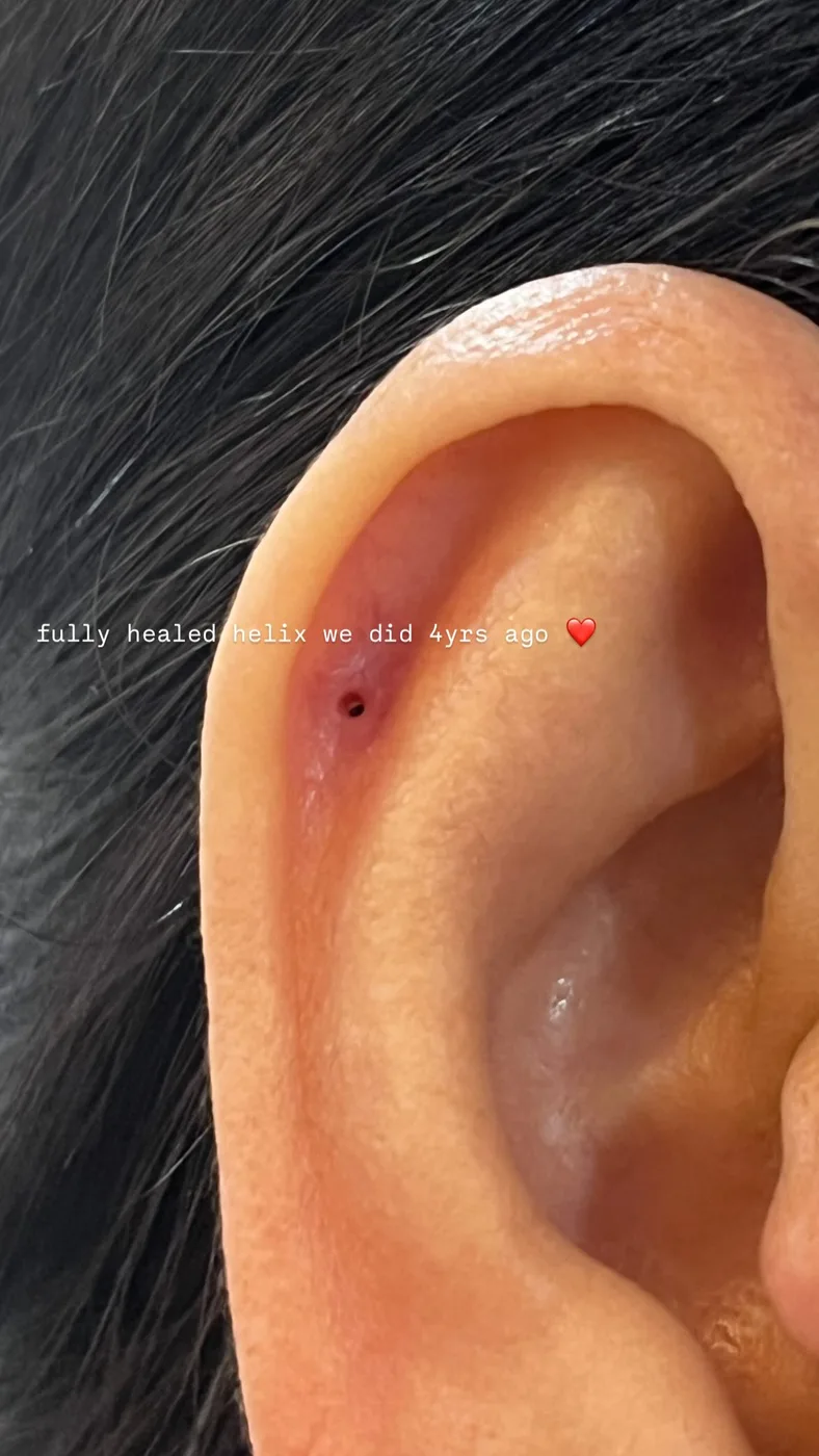 Fully healed helix piercing hole shown without jewelry, done four years earlier